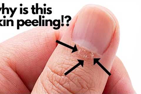 Cuticle Peeling After a Manicure?