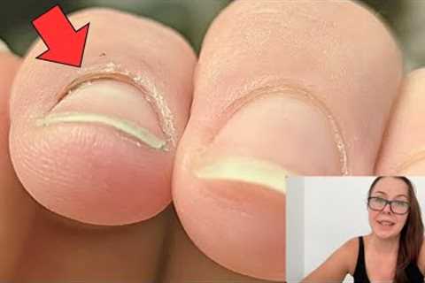 Why would skin separate from the nail. [Pro Nail Tech explains]